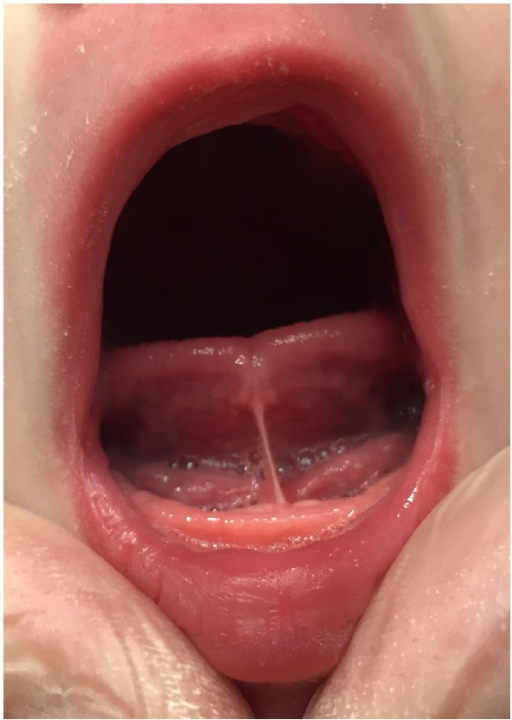 Read more about the article Feeding After Tongue Tie Release